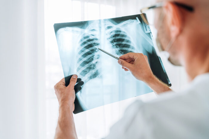 Male doctor examining the patient chest x-ray film of a lung scan at a radiology department in a hospital.