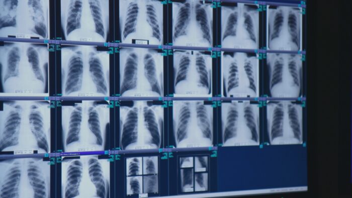 Several lung x-rays are shown on a screen.