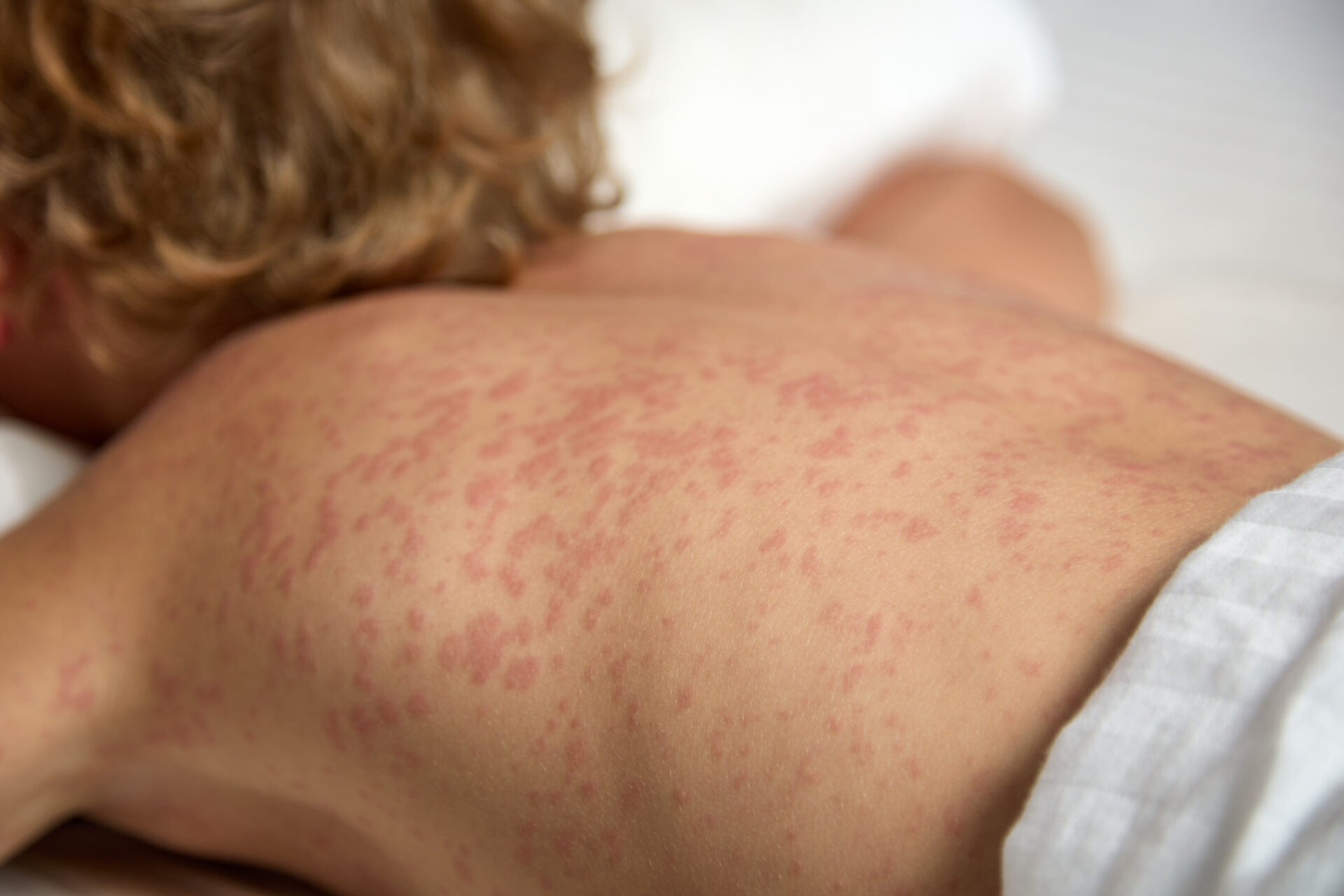 W.Va. Is One Of 20 U.S. States Without A Measles Case This Year